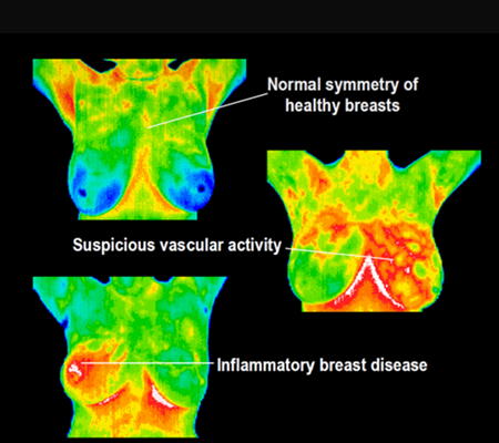 Image of 3 thermal images of breast disease