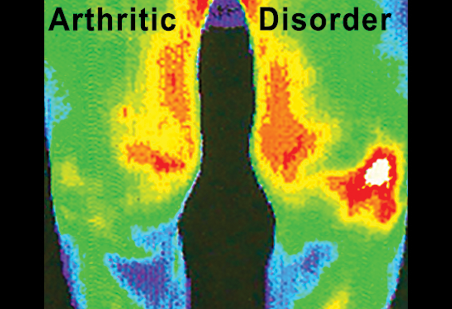 Thermal image of arthritic knees
