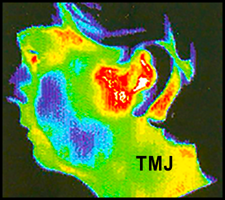Thermal image of TMJ
