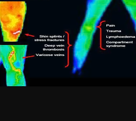 image of thermal leg disorders
